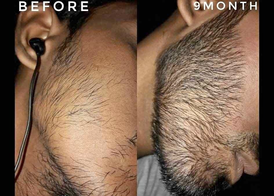 BEARD growth OIL🧂 - 3
